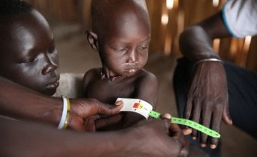 Conflict and displacement has caused widespread malnutrition in Unity State. Photo: Kieran McConville / Concern Worldwide