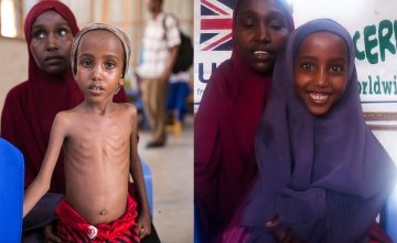 Before and after of Somali refugee girl Yasmiin Hassan, aged five, from arrival at Concern Worldwide clinic in Mogadishu, Somalia, on March 15, 2017 and 12 weeks later after treatment for severe acute malnutrition. Her family fled war and drought. 