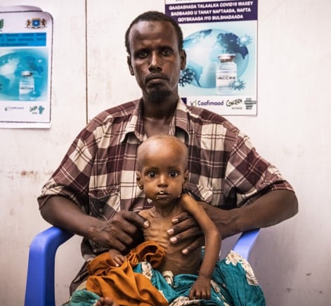 Concerned man sitting in blue plastic chair with child suffering from malnutrition sitting on his lap