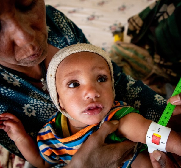Azalu Tamu brings her twin girls Tineay and Asmra to a Concern nutrition centre in Amhara, Ethiopia. The girls are screened for malnutrition using MUAC tape, which measures the mid-upper arm circumference. This measurement is a low-tech and reliable way of checking for malnutrition — and another way of “measuring” hunger. (Photo: Eugene Ikua/Concern Worldwide)