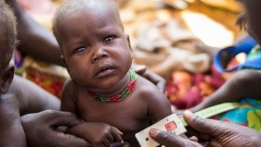 14 month old Chan Adim Garang, a girl, is one of twins admitted to the outpatient therapeutic program (OTP) run by Concern in Maduany in Aweil North, South Sudan. Photo: Kieran McConville / Concern Worldwide