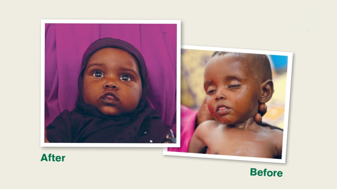 Before and after photo of Nala. Photo: Concern Worldwide.