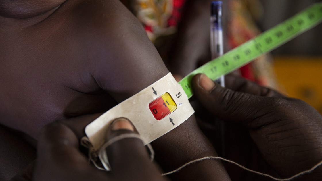 A child gets MUAC measurement assessed by a nutrition assistant at a Nutrition Centre in Gambella, Ethiopia.