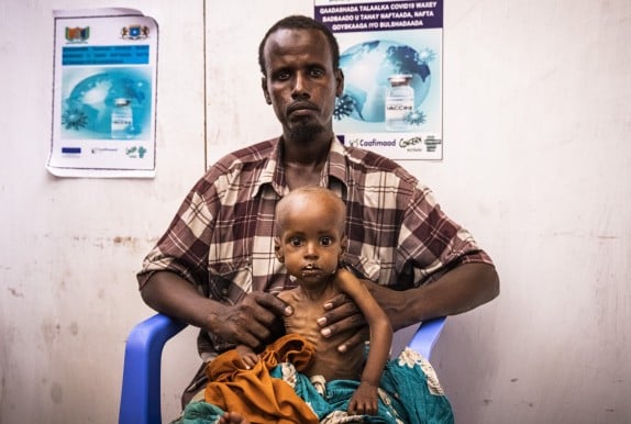 Concerned man sitting in blue plastic chair with child suffering from malnutrition sitting on his lap