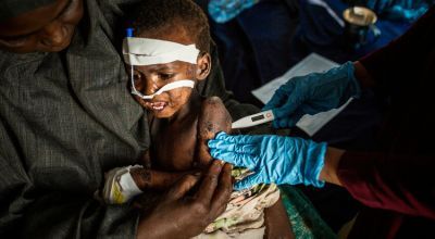 A nurse checks on 3 year old Jamel who has measles and a fever at Banaadir hospital in Mogadishu. His family had to leave their village due to drought. Photo by Mustafa Saeed for Concern Worldwide